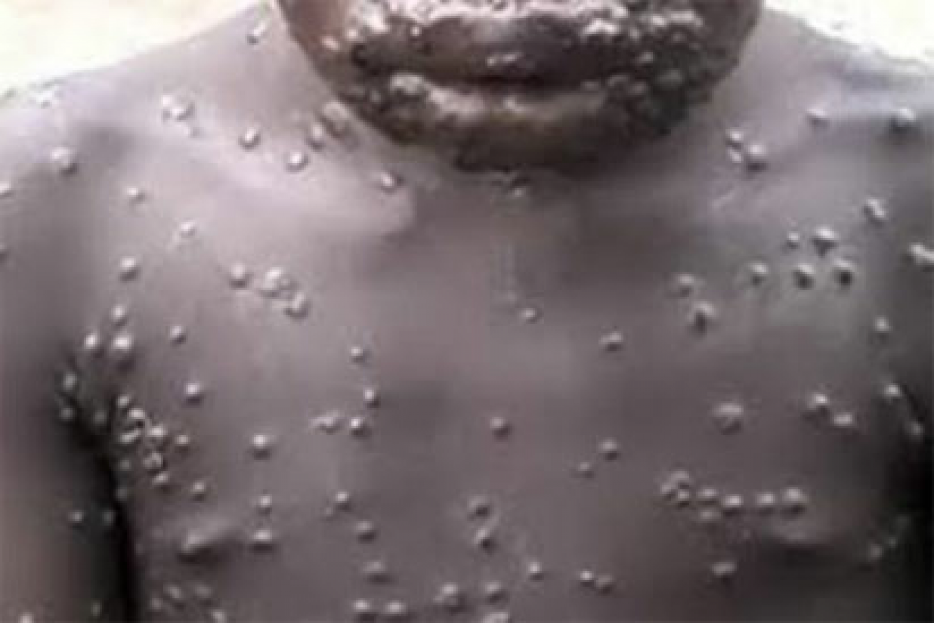 MonkeyPox cases now recorded in Lagos, Six other states -NCDC