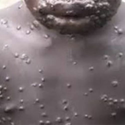 MonkeyPox cases now recorded in Lagos, Six other states -NCDC