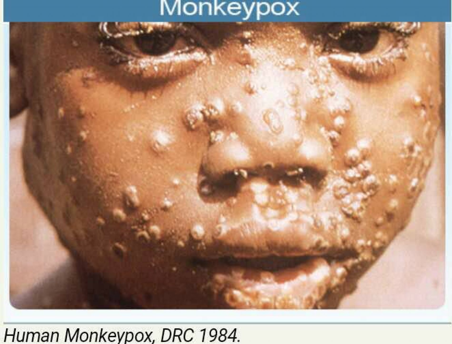 Monkeypox outbreak hits Nigeria
