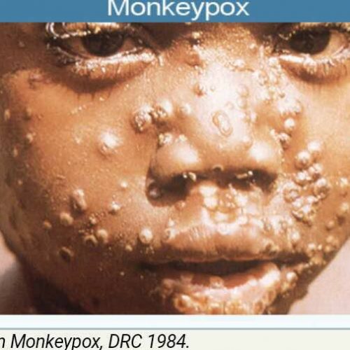 Monkeypox outbreak hits Nigeria